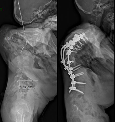 xray before and after (side view)