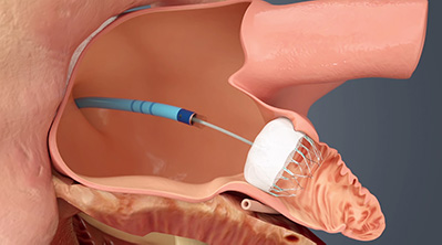 WATCHMAN™ Left Atrial Appendage Closure
Device,