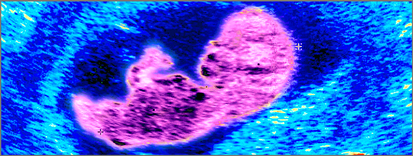 Embryo on ultrasound
