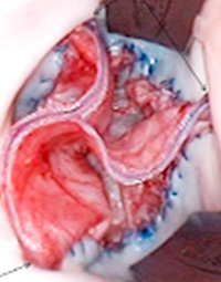 Ozaki aortic valve repair