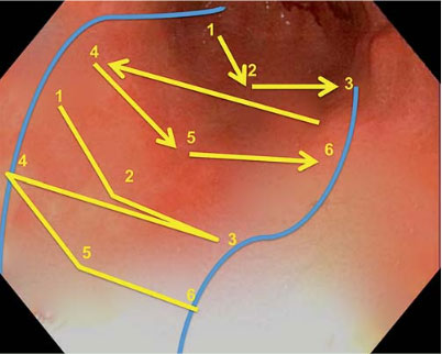 EndoscopicSleeveGastroplasty-suture-pattern