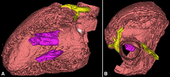 3D computer generated image of heart from two different angles