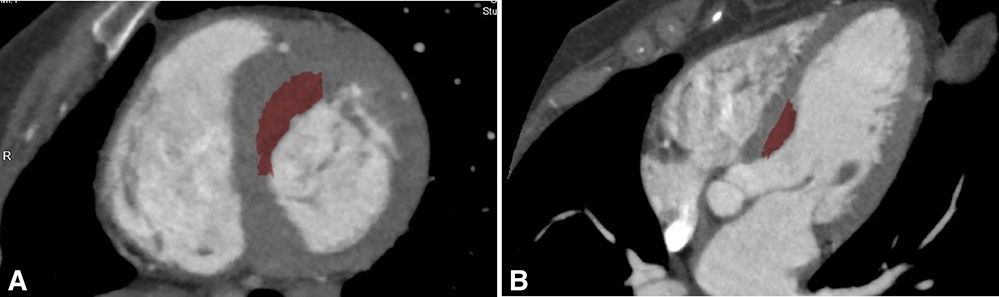 x-ray images of left and right ventricle on gated CT