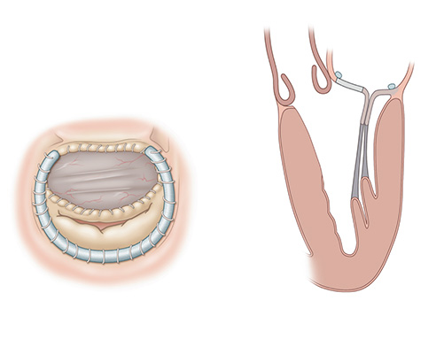illustration of two different views of Robotic septal myectomy with anterior leaflet patch.