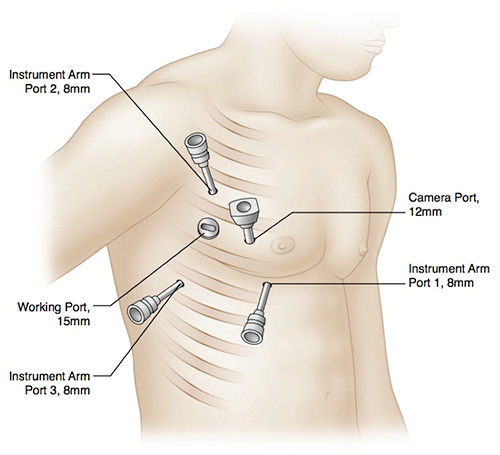 illustration of endoscopic robotic septal myectomy ports
