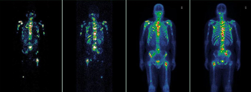 Scan results of targeted molecular therapy