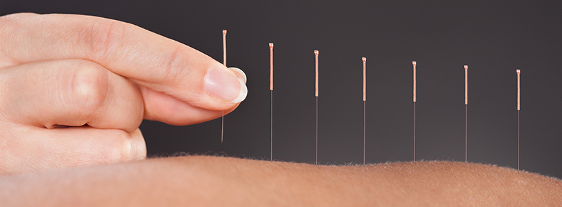 Close up of acupuncture