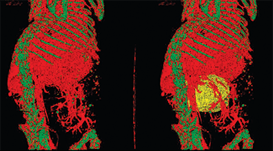 an abdominal tumor is revealed (yellow) that left a void in the abdominal vasculature