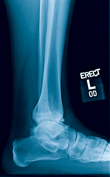 close-up x-ray of human leg