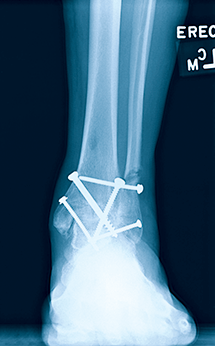 foot x-ray img 3