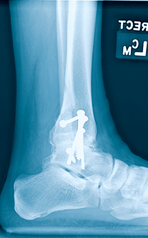 close-up x-ray of foot and ankle