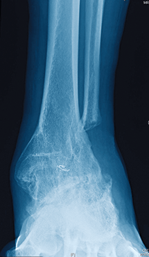 foot x-ray img 5