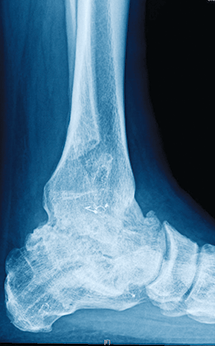 close-up x-ray of foot and ankle