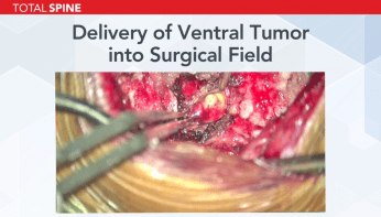 up-close of ventral tumor surgery