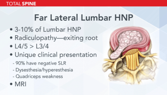 far lateral lumbar presentation slide