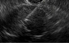 cadc-endoscopic-ultrasound