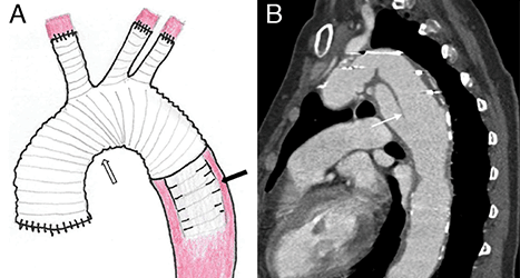 Schematic of the elephant trunk