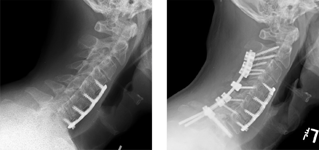 cervical-spine-surgery-before-after.jpg