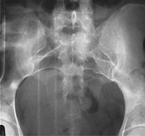x-ray of pelvis