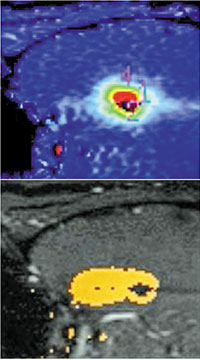 Real-time MR thermography and Composite irreversible damage zone