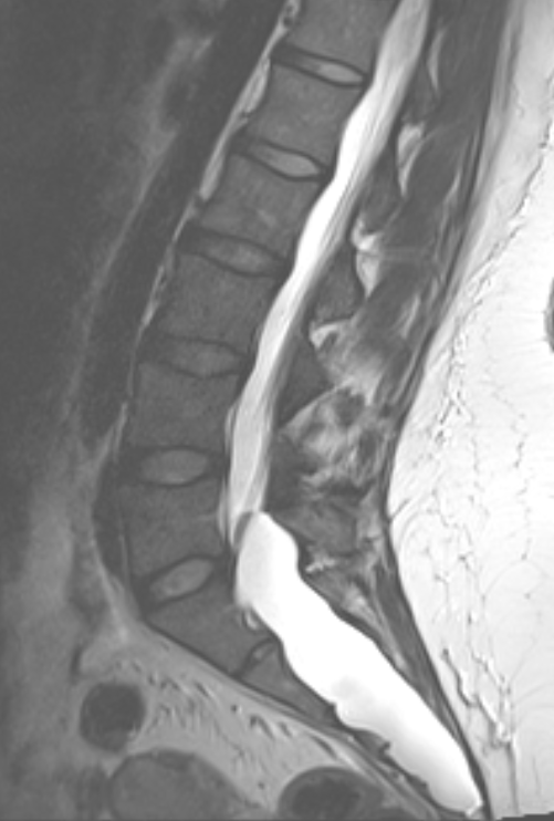 MRI image of spine