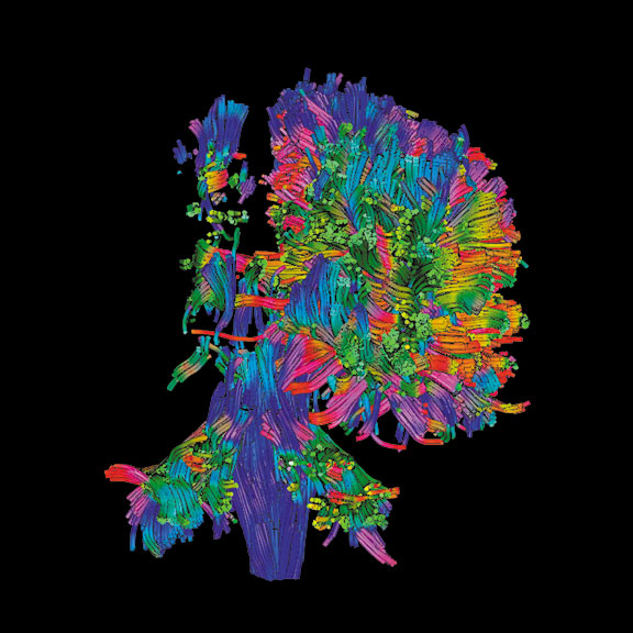 3-D diffusion tensor imaging scan of a rear view of the brain