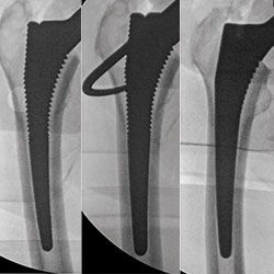optimizing femoral sizing and filling of the
femoral canal