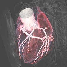 radiology-low-dose-ct-cardiac-imaging-heart.jpg
