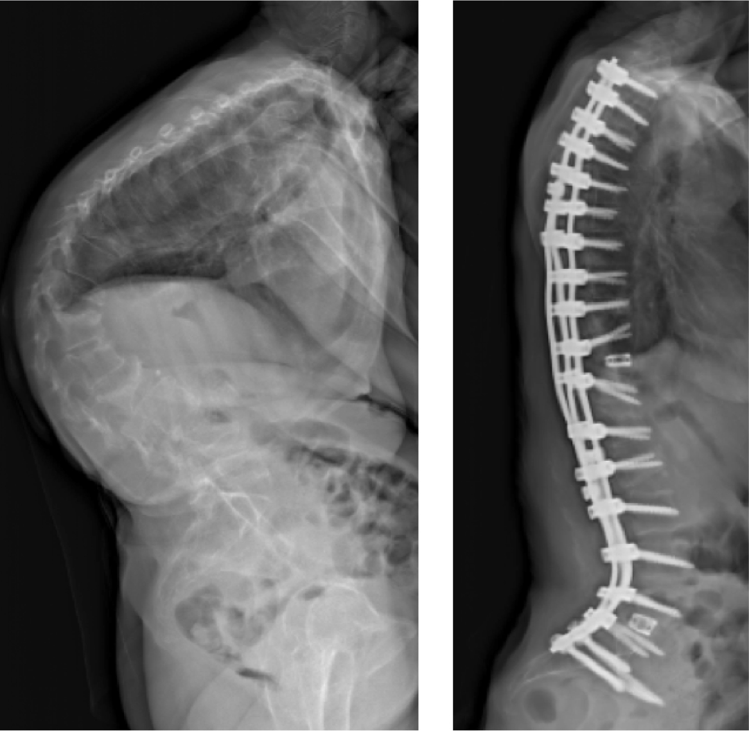 severe-kyphosis-before-after