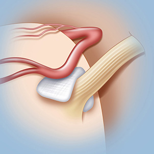 illustration of microvascular decompression surgery