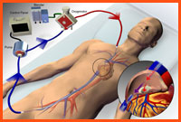 ECMO with two site cannulation.