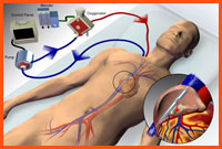 ECMO with single site cannulation.