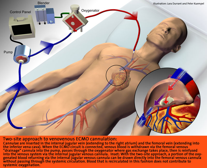 ECMO with two site cannulation. Click image to enlarge.