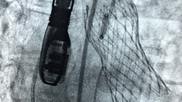 Transcatheter biological aortic valve replacement, while being monitored with a transesophageal echocardiogram