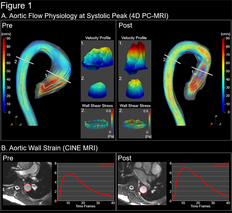 image of Aortic Flow physiology at systolic peak and Aortic wall strain