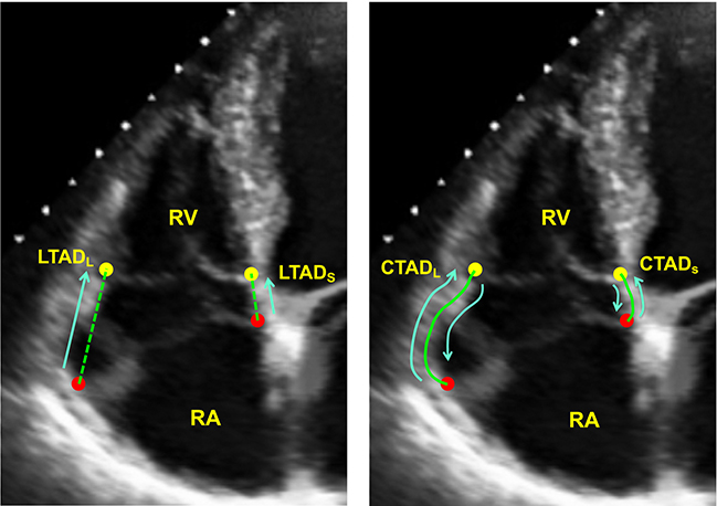 image of lateral and septal annular displacement performed both manually and by machine learning algorithm