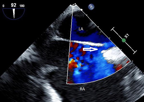 a visualization of PFO by transesophageal echocardiography