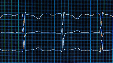 image of a normal ECG with arrhythmia elements