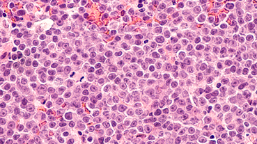 photomicrograph of a diffuse large B-cell lymphoma (DLBCL)