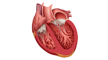 vector illustration of a heart with a dilated left ventricle