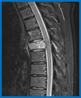 image of a Pathological fracture in the spine