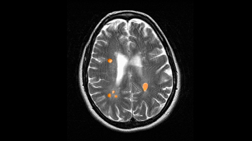 brain MRI of multiple sclerosis