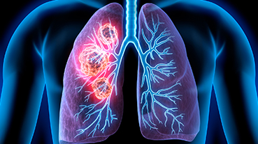 digital medical illustration of lung cancer in the lungs