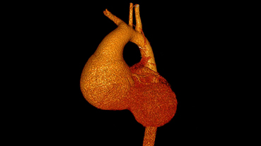 vector image of CT of ascending aortic aneurysm