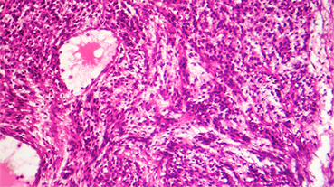 image of Fibrosarcoma, light micrograph, photo under microscope