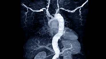 image of CTA whole aorta with curve MPR technique showing abdominal aorta and left, right iliac artery showing aortic dissection