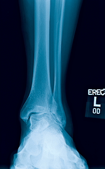 foot x-ray img 2