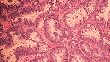 Microscopic image of colonic adenocarcinoma with hematoxylin and eosin stain