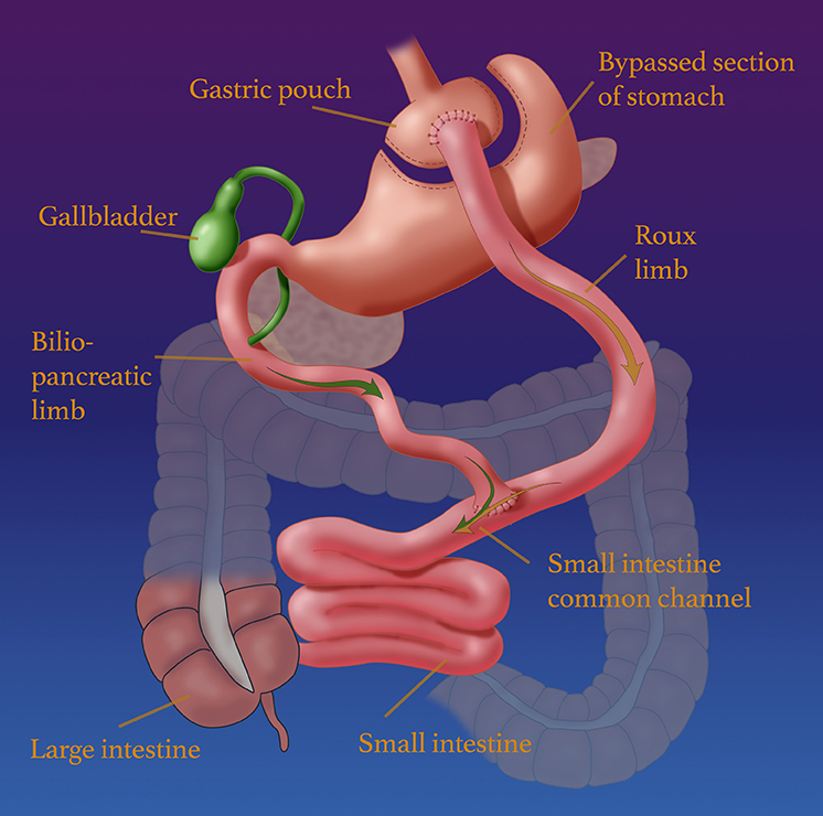 Diagram of Bariatric bypass surgery