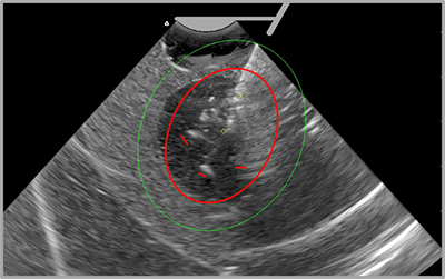 close-up ultrasound of uterine fibroids
